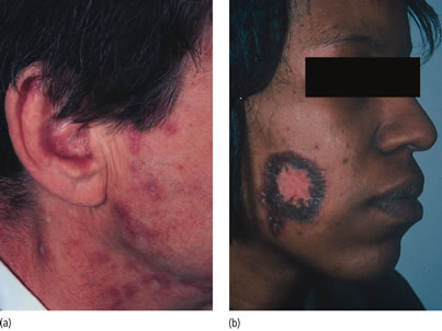 discoid lupus erythematosus dle